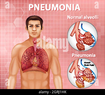 Comparaison d'alvéoles saines et de pneumonie Illustration de Vecteur