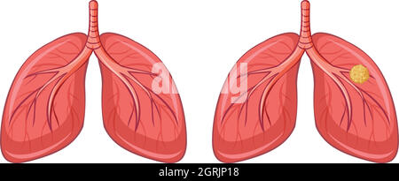 Poumons humains et cancer Illustration de Vecteur