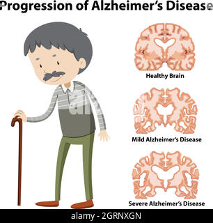 Progression de la maladie d'Alzheimer Illustration de Vecteur