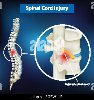 Schéma montrant une lésion de la moelle épinière Illustration de Vecteur