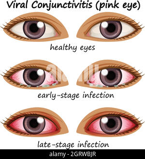 Conjuctivitis viral dans les yeux humains Illustration de Vecteur