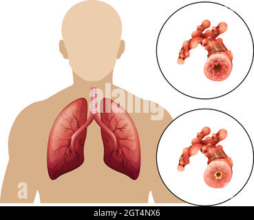 Maladie pulmonaire obstructive chronique humaine Illustration de Vecteur