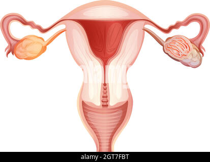 Cancer de l'ovaire chez la femme Illustration de Vecteur