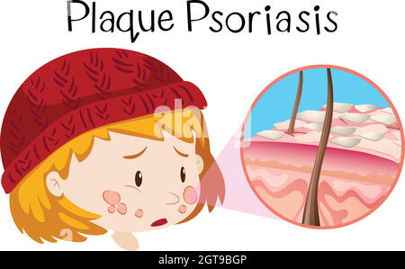 Anatomie humaine du psoriasis en plaques Illustration de Vecteur