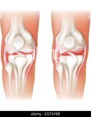 Arthrite du genou humain Illustration de Vecteur