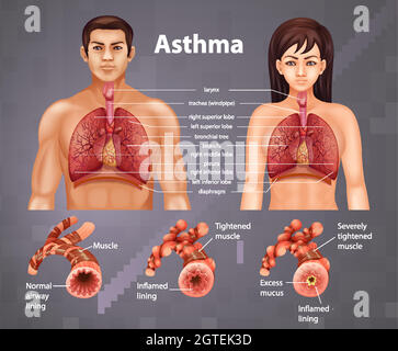 Comparaison des poumons sains et des poumons asthmatiques Illustration de Vecteur