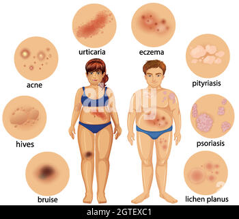 Schéma montrant différentes maladies de la peau Illustration de Vecteur