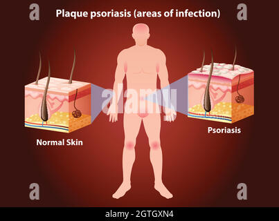 Schéma montrant le psoriasis en plaques chez l'homme Illustration de Vecteur