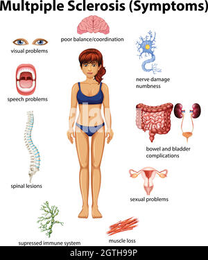 Une affiche d'éducation sur la sclérose en plaques Illustration de Vecteur