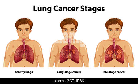 Illustration informative des stades du cancer du poumon Illustration de Vecteur