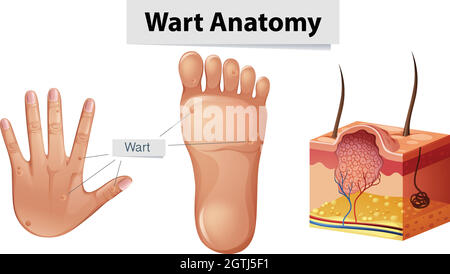 Anatomie humaine Wart sur la main et le pied Illustration de Vecteur