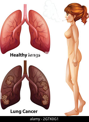 Anatomie humaine poumon de Smoker Illustration de Vecteur