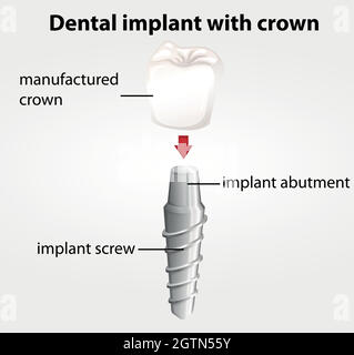 Implant dentaire avec couronne Illustration de Vecteur