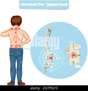 Schéma illustrant un disque hernié Illustration de Vecteur