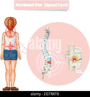 Schéma illustrant un disque hernié Illustration de Vecteur