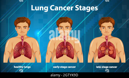 Illustration informative des stades du cancer du poumon Illustration de Vecteur