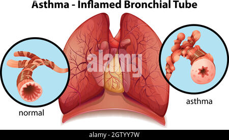 Tube bronchique à inflammation d'asthme Illustration de Vecteur