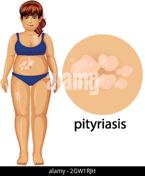 Femme avec pityriasis sur fond blanc Illustration de Vecteur