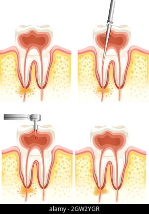 Canal racinaire dentaire Illustration de Vecteur
