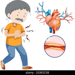 Un problème cardiaque humain sur fond blanc Illustration de Vecteur