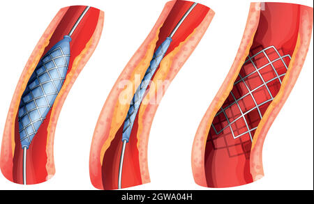 Stent utilisé pour ouvrir l'artère bloquée Illustration de Vecteur