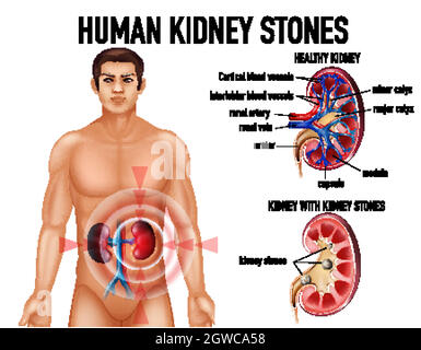 Comparaison des reins et des reins sains avec des pierres Illustration de Vecteur