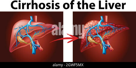 Schéma montrant la cirrhose du foie Illustration de Vecteur