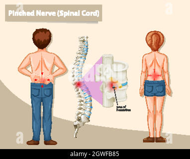 Schéma montrant le nerf pincé chez l'homme Illustration de Vecteur