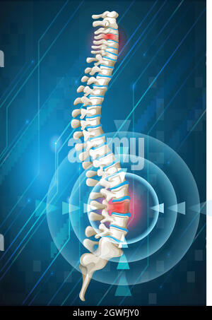 Colonne vertébrale humaine présentant des douleurs dorsales Illustration de Vecteur
