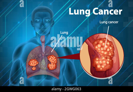 Illustration informative du cancer du poumon Illustration de Vecteur