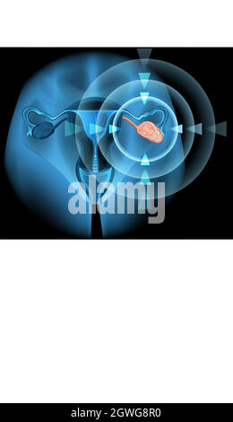 Diagramme de cancer de la Overian en détail Illustration de Vecteur