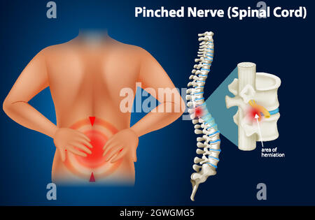 Schéma montrant le nerf pincé Illustration de Vecteur