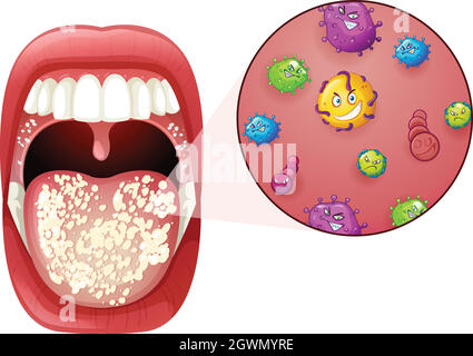 Une infection par le virus de la bouche humaine Illustration de Vecteur