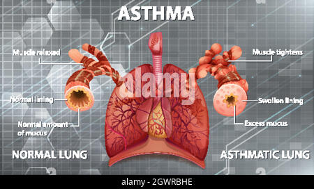 Comparaison des poumons sains et des poumons asthmatiques Illustration de Vecteur