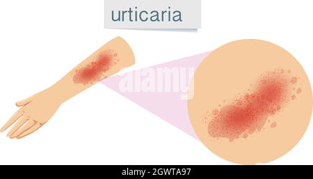Un problème de peau humaine urticaire Illustration de Vecteur