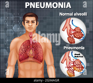 Comparaison d'alvéoles saines et de pneumonie Illustration de Vecteur