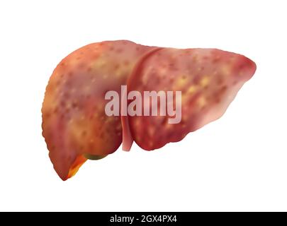 Illustration vectorielle réaliste de la cirrhose du foie humain isolée sur blanc Illustration de Vecteur