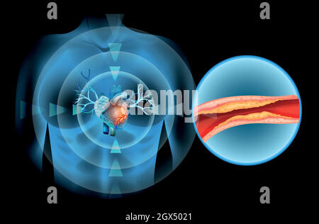 Cholesteral pointé dans le coeur humain Illustration de Vecteur