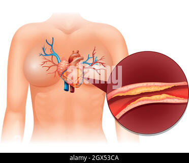 Coeur Cholesteral chez l'homme Illustration de Vecteur