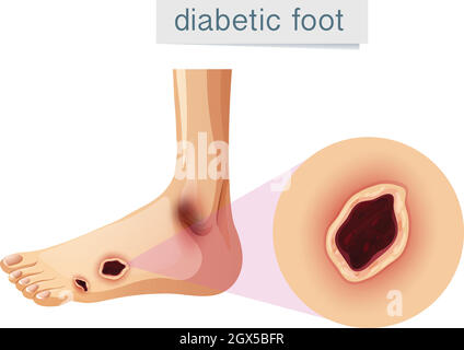 Pied diabétique magnifé sur le pied Illustration de Vecteur