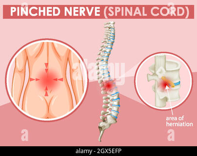 Schéma montrant le nerf pincé chez l'homme Illustration de Vecteur