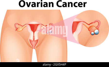 Schéma montrant le cancer de l'ovaire Illustration de Vecteur