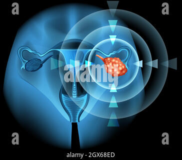 Diagramme de cancer de la Overian en détail Illustration de Vecteur