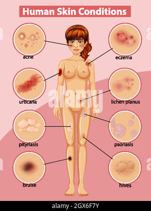 Schéma illustrant les conditions de la peau humaine Illustration de Vecteur