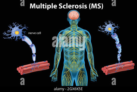 Anatomie humaine de la sclérose en plaques Illustration de Vecteur