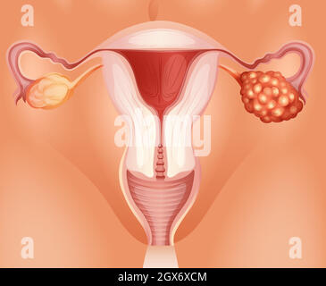 Cancer de l'ovaire chez la femme Illustration de Vecteur