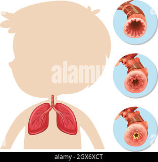 Une anatomie de Boy Silhouette Lung Illustration de Vecteur