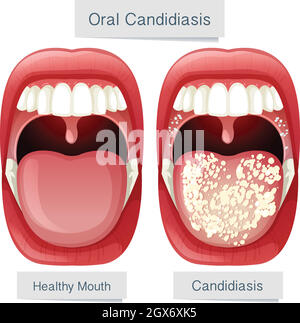 Bouche humaine Anatomie candidose orale Illustration de Vecteur