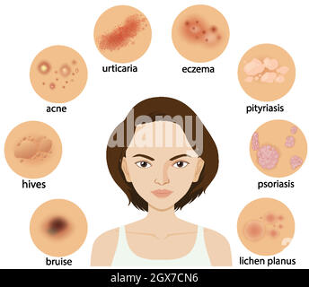 Schéma montrant différentes conditions cutanées Illustration de Vecteur