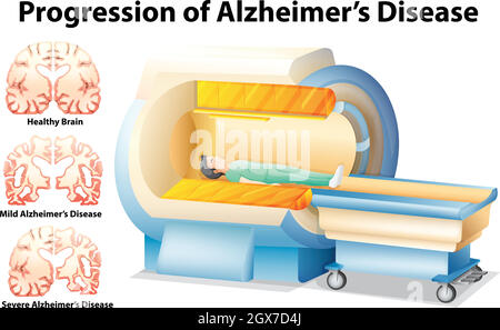 Progression de la maladie d'Alzheimer Illustration de Vecteur